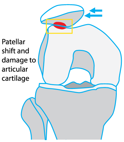 patella 충돌.gif