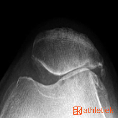 patella 충돌2.jpg